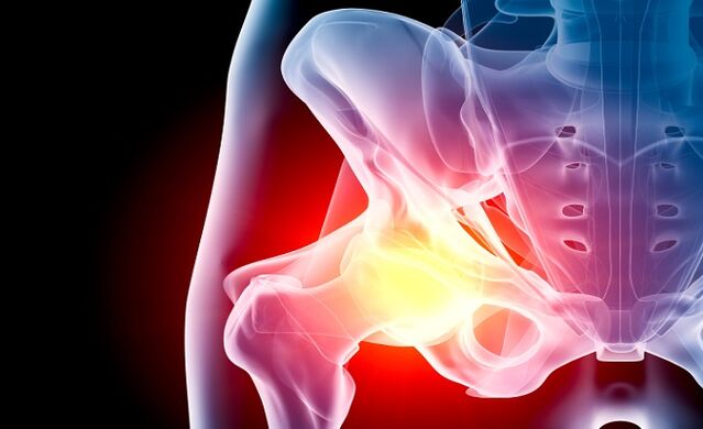 arthrosis na hip hadin gwiwa