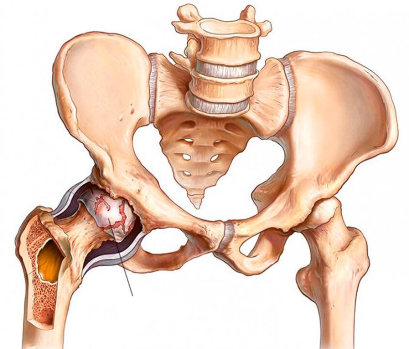 Arthrosis na haɗin gwiwa na hip