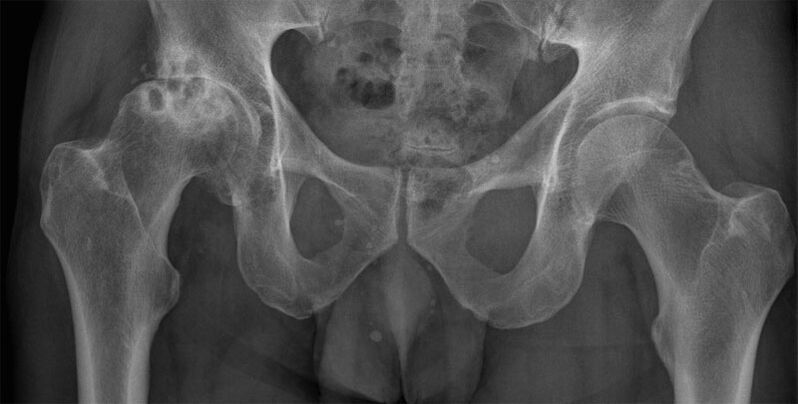 Lalacewar arthrosis na haɗin gwiwa na hip akan x-ray