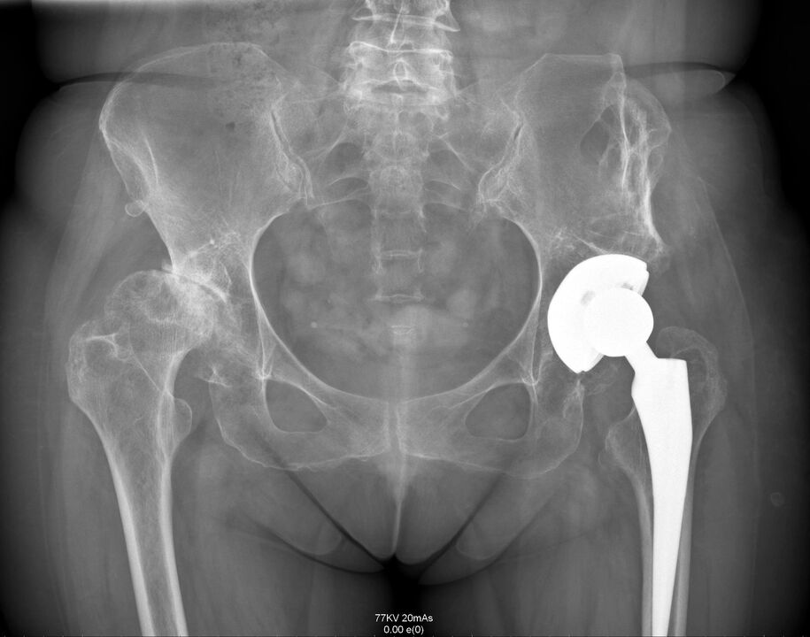 X-ray na hip hadin gwiwa bayan arthroplasty