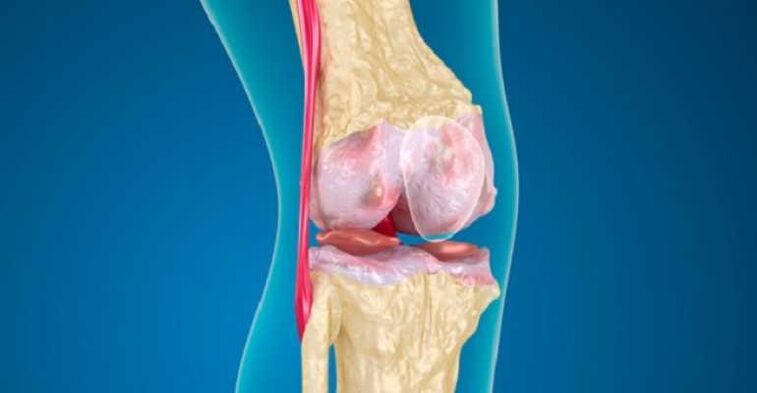 Arthrosis na cutar hadin gwiwa, wanda ke haifar da lalata carilage a cikin gidajen abinci