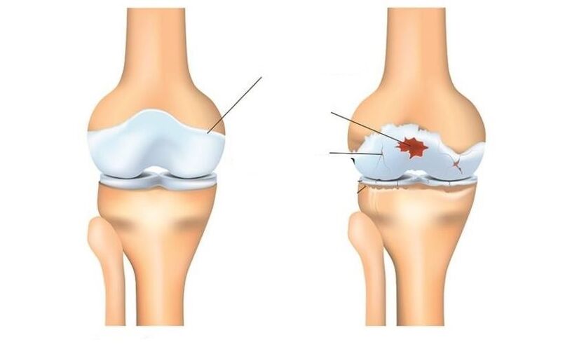 Lafiya da haƙuri tare da kayan haɗin arthrosis
