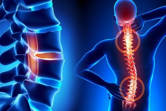Osteochondrosis na kashin baya