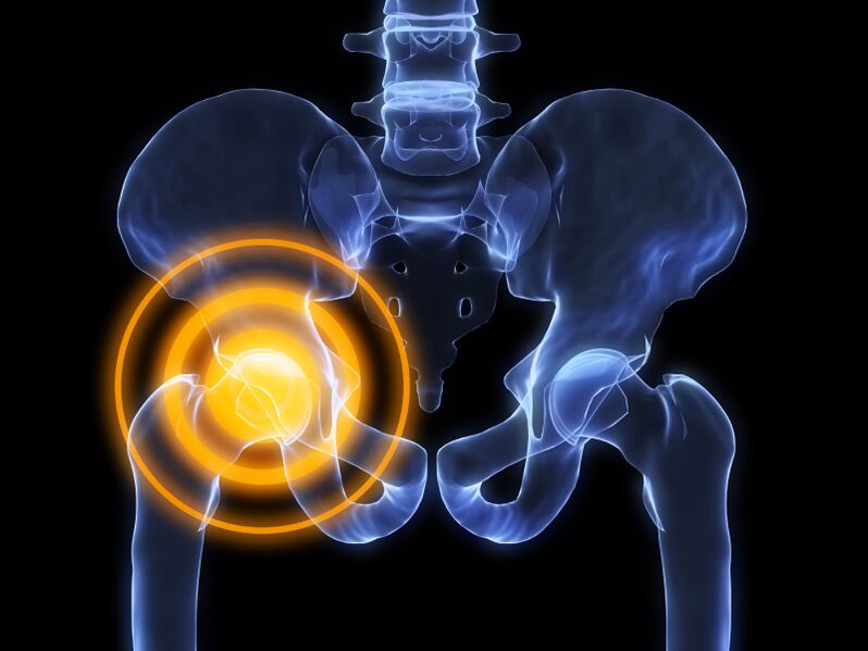 arthrosis na hip hadin gwiwa