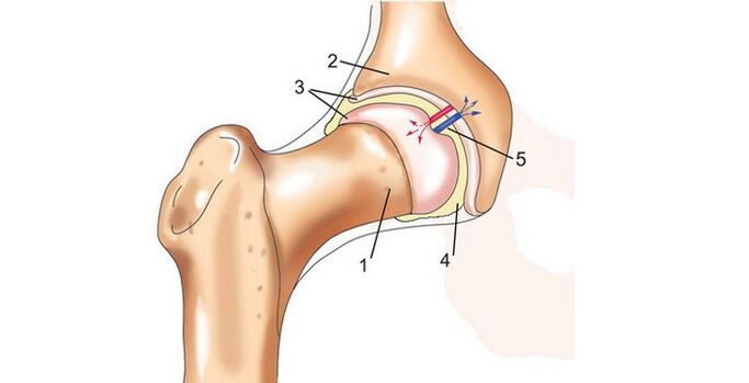 hip hadin gwiwa da arthrosis